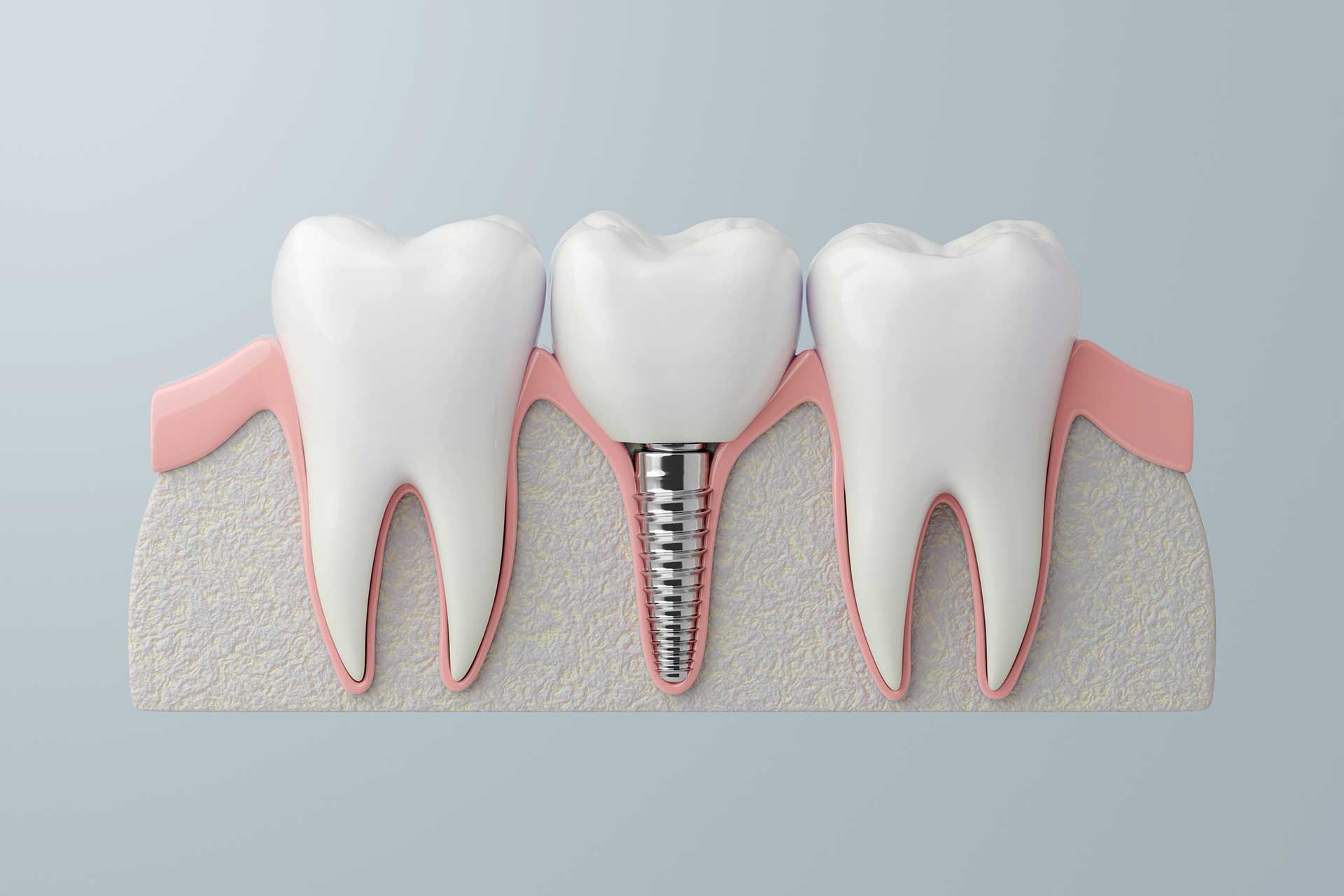 Pioneering Pain Management Techniques in Dental Implant Procedures