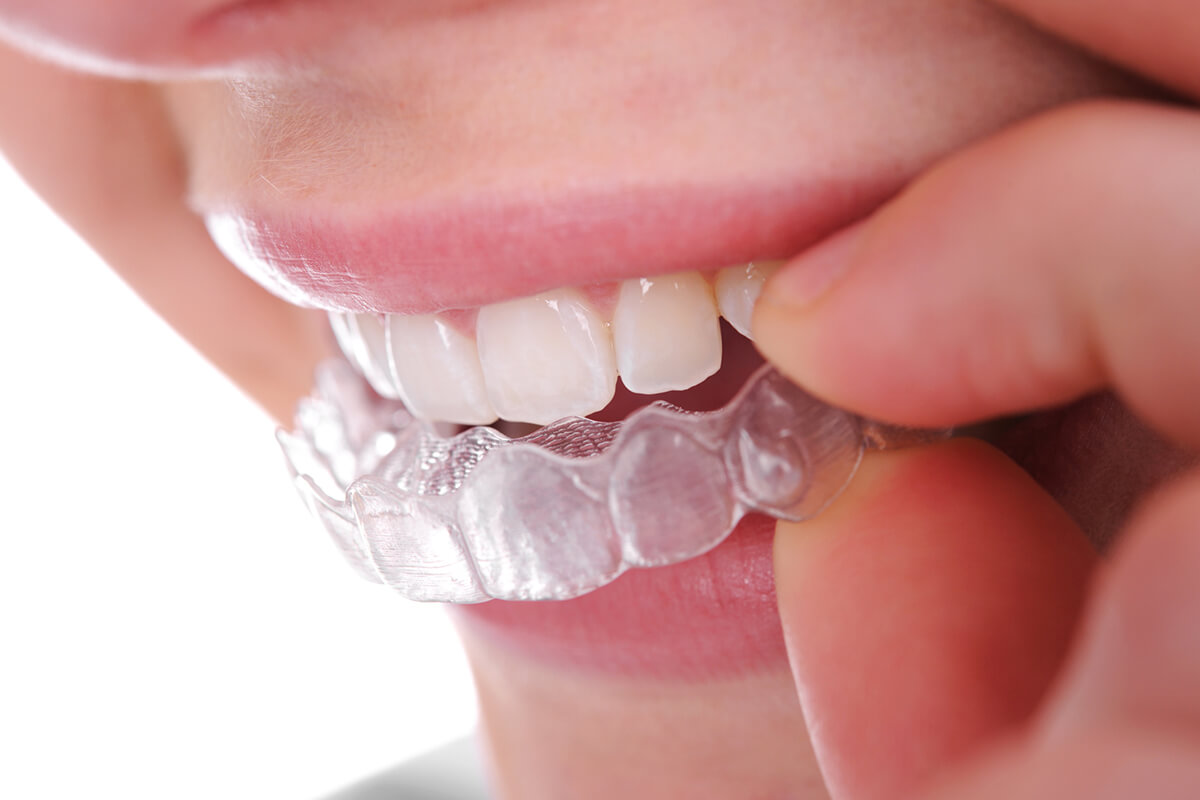 Invisalign: A Modern Approach to Pain-Free Orthodontics